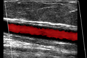 ultrasound image demonstrating venous reflux using color doppler