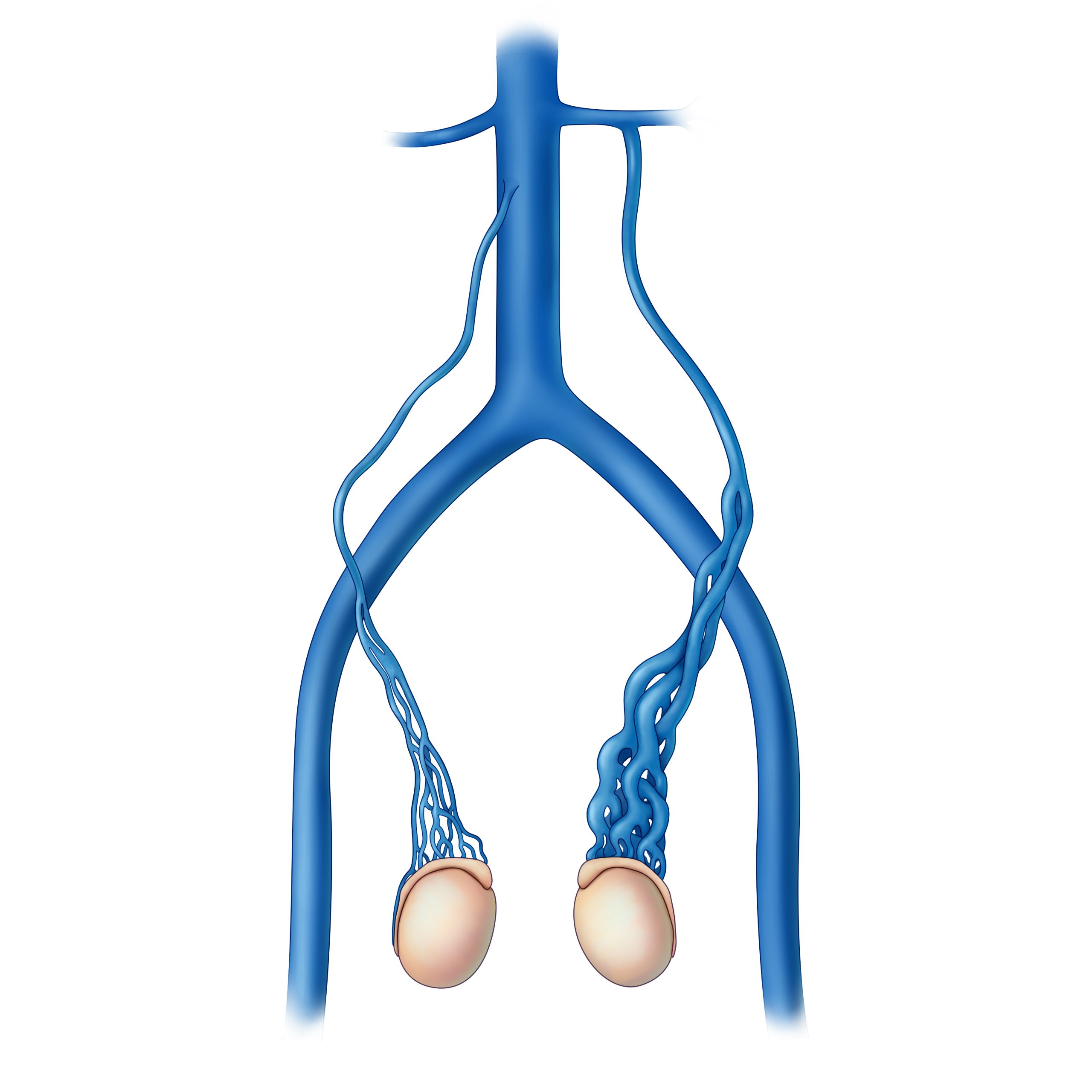 Sperm count after varicoceles surgery