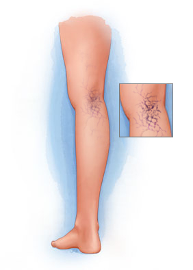 Varicose Veins and Spider Veins Causes and Treatments