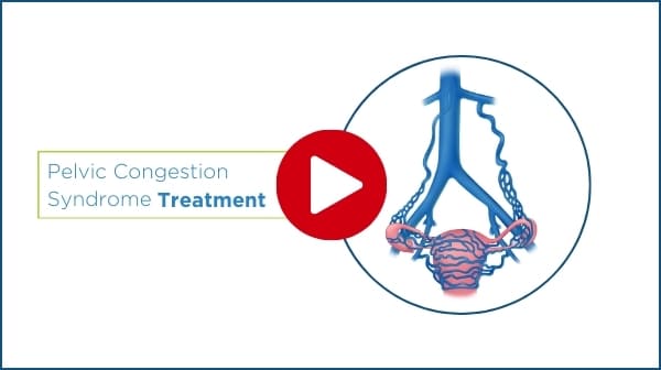 play pelvic congestion syndrome treatment video