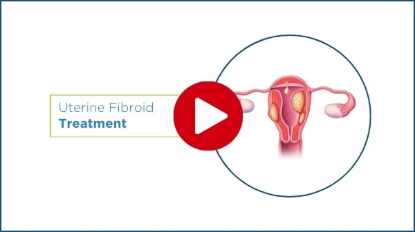 play uterine fibroid treatment video