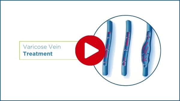 play varicose vein treatment video