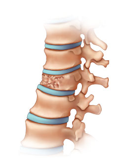 Compression fracture treatments: Options and recovery