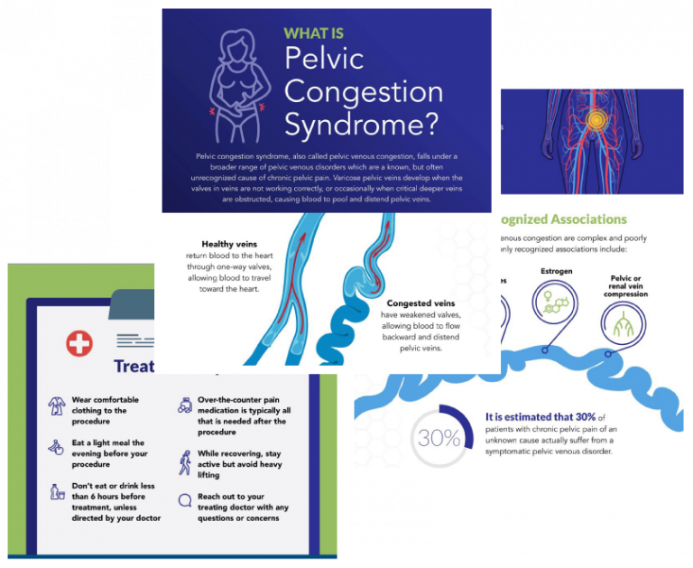 Pelvic venous congestion syndrome: female venous congestive syndromes and  endovascular treatment options, CVIR Endovascular