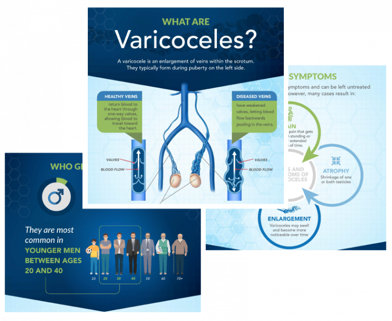 Varicoceles Causes, Symptoms And Treatments