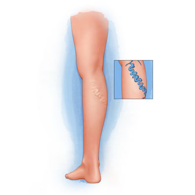 How Compression Stockings Treat Varicose Veins - St. johns Vein Center